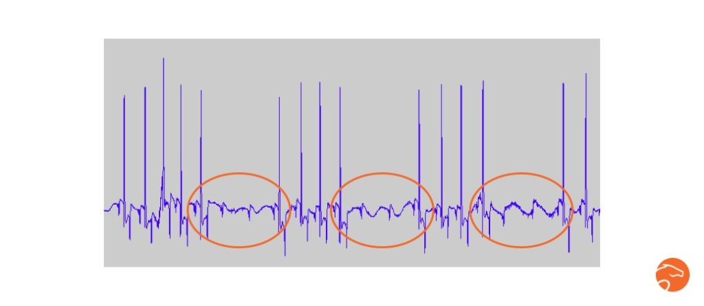 Exemple d'arythmie (bloc atrio-ventriculaires), mesurées chez un cheval avant le travail, grâce au cardiofréquencemètre Equisense Motion S