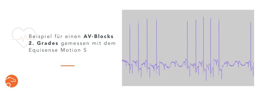 Atrioventrikulärer Block (AV-Block) 2. Grades